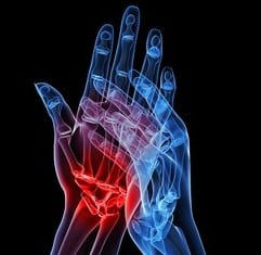Magnet Therapy for Rheumatoid Arthritis