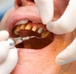 Post image for Gums Provide Clues to Rheumatoid Arthritis Severity