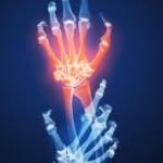 The Major Kinds of Arthritis