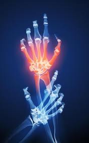 Post image for The Major Kinds of Arthritis
