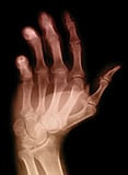 arthritis_hand