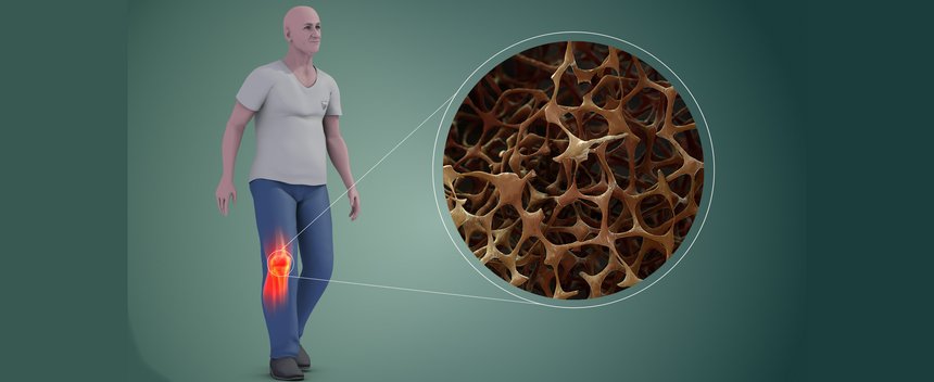 Osteoporosis in Bones
